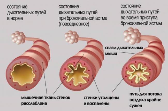 Первые признаки бронхиальной астмы: как не упустить момент