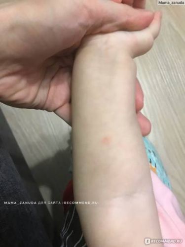 Делают ли манту при кашле и насморке