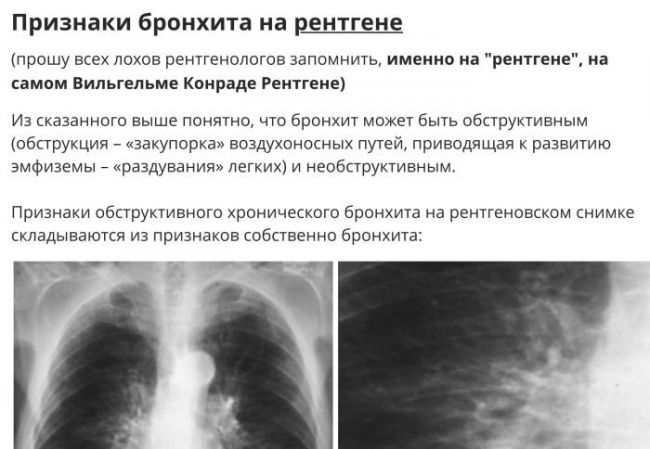 Виды рентгена при пневмонии у детей и примеры снимков