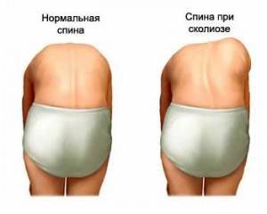 Как лечить сколиоз 2 степени у взрослых
