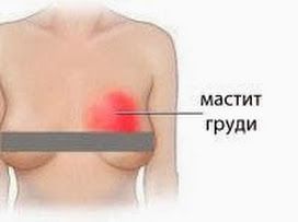 Причины, симптомы, лечение и профилактика воспаления молочных желез у женщин