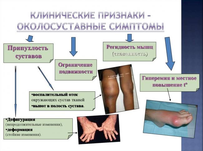 Остеоартрит