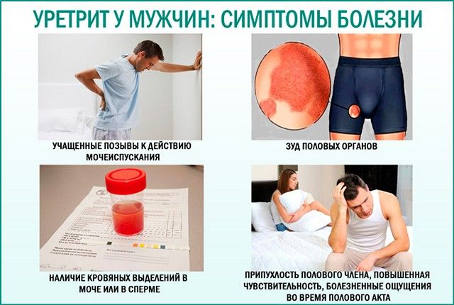 Лечение выделений из уретры