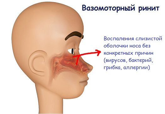 Вазомоторный ринит — что это такое, причины, симптомы и лечение у взрослых