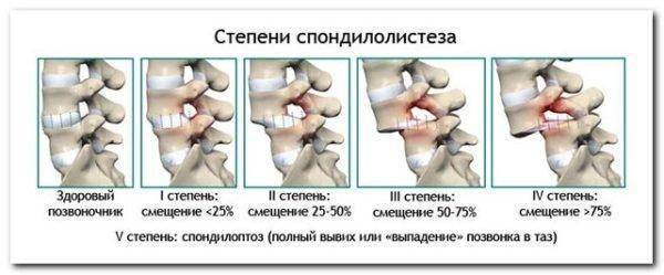 Лечебная гимнастика для позвоночника при грыже поясничного отдела