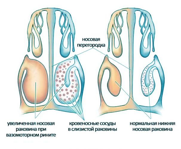 Мазь от геморроя при беременности флеминга