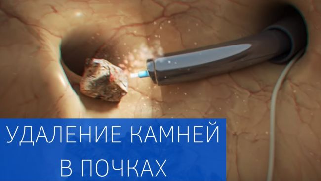 Чем лечить песок в почках