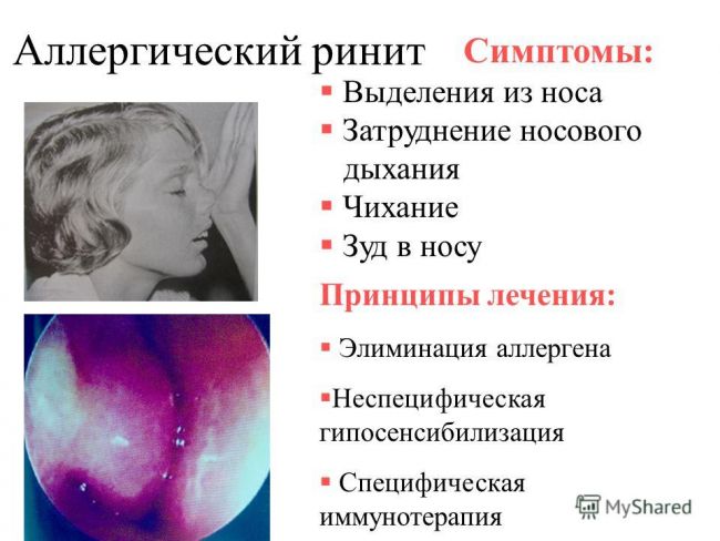 Аллергический насморк - симптомы и лечение у взрослых и детей, препараты | здрав-лаб