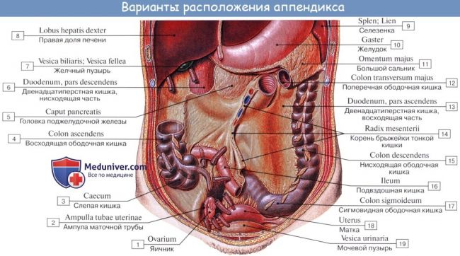 Особенности течения острого аппендицита при атипичном расположении червеобразного отростка