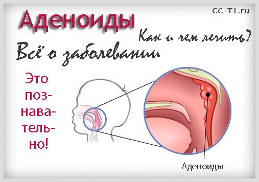 Аденоиды у детей