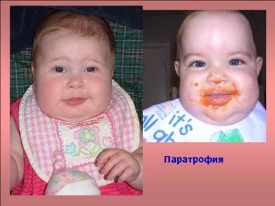 Что значит диатез у новорожденных