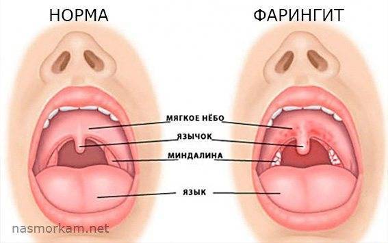 Болит горло, больно глотать, температуры нет и отдает в уши: чем лечить, что делать?