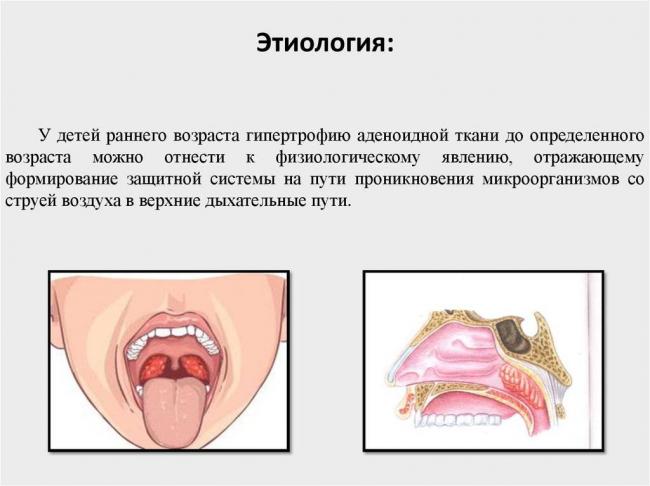 Острый и хронический аденоидит – симптомы, лечение, аденоидит у детей