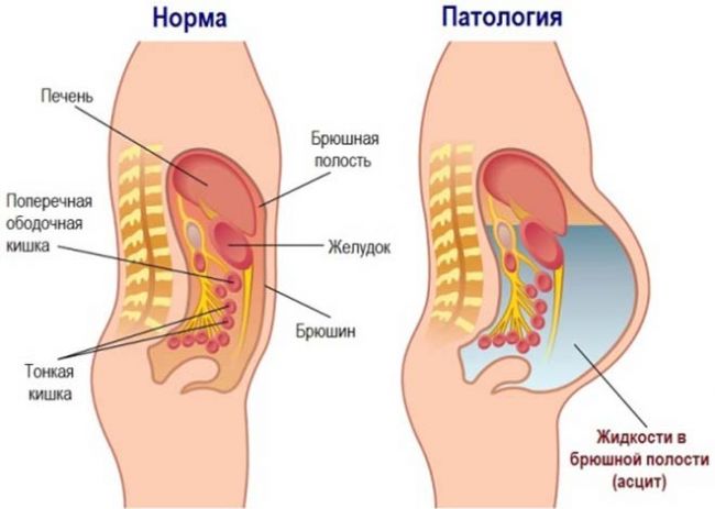 Лапароцентез: обследование для выявления повреждённых внутренних органов