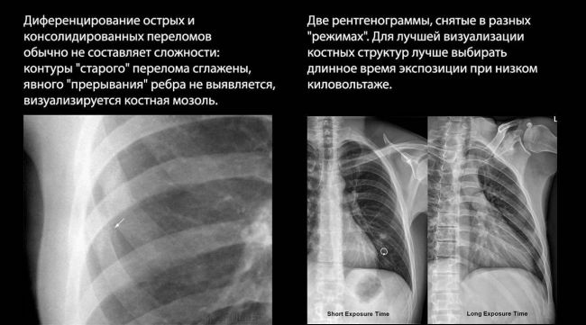 Когда делают рентгенографию легких