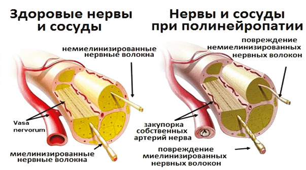 Диабетическая полинейропатия нижних конечностей: как распознать и вылечить?