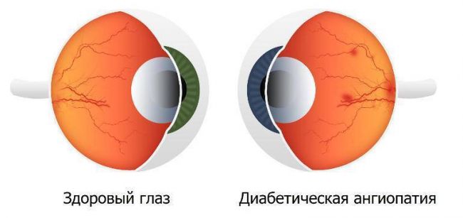 Ангиопатия сетчатки обоих глаз: что это такое, симптомы, лечение
