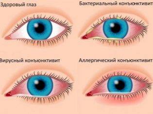 Тетрациклиновая мазь при ячмене