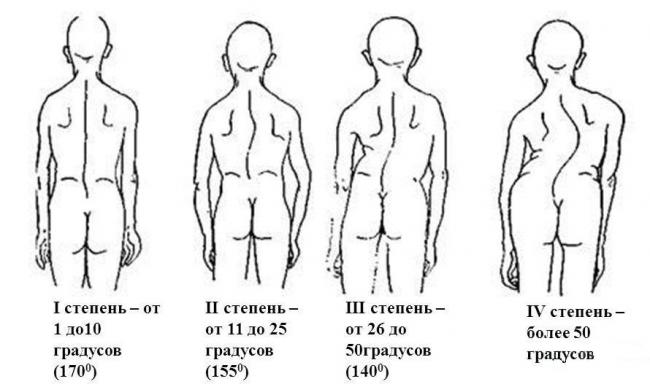Сколиоз позвоночника у взрослых. лечение: гимнастика, народные средства, массаж, корсеты, операция