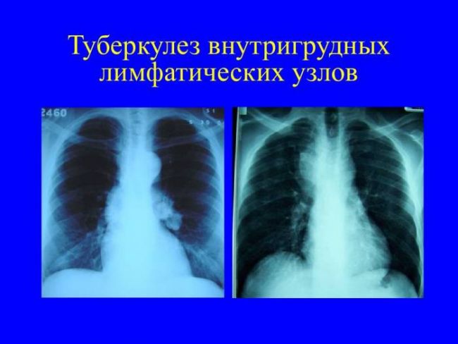 Туберкулез лимфоузлов: первые признаки и методы лечения
