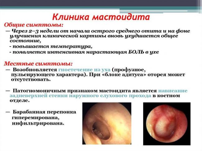 Мастоидит: симптомы, лечение, прогноз, характеристика