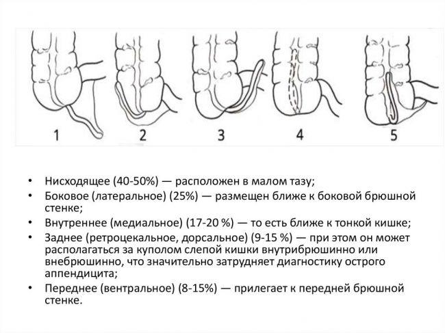 Аппендицит. причины, симптомы, диагностика и лечение.