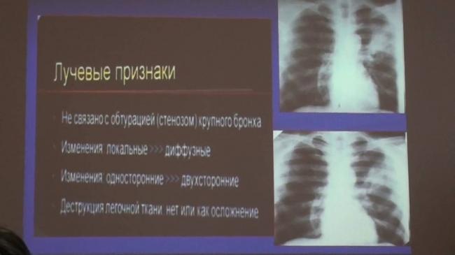 Наиболее эффективные антибиотики при пневмонии