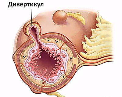Меню после операции на кишечнике через месяц