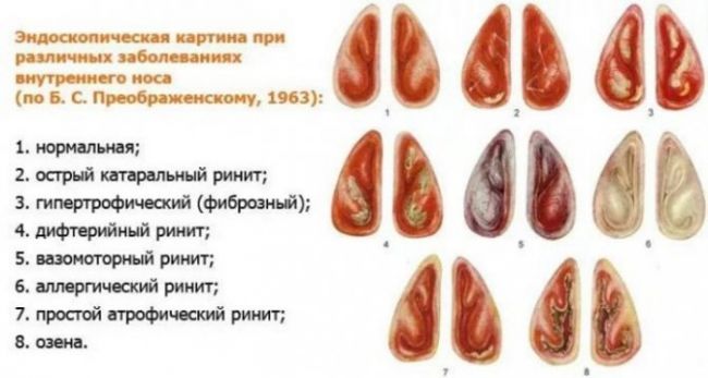 Если заложен нос и капли не помогают: что делать?