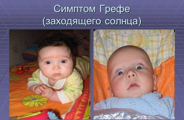 Внутричерепное давление у ребенка: симптомы, признаки, причины. лечение внутричерепного давления у ребенка. внутричерепная гипертензия у детей