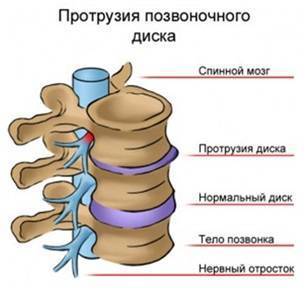 Сколько дней температура при остеохондрозе?