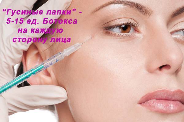 Что делать, если после ботокса опустилось верхнее веко?