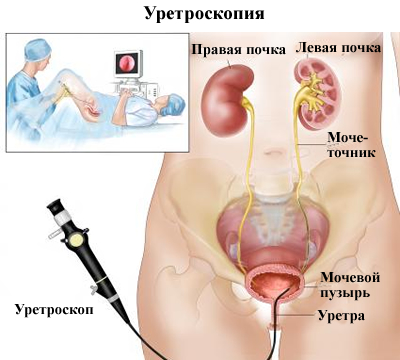 Лечение камней в почках народными средствами