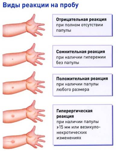 Можно ли делать манту, если ребенок болеет: влияние на результаты