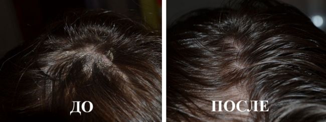 Ретиноевая мазь (retinoic ointment)