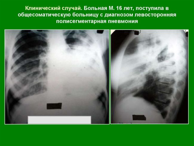 Инфильтративный туберкулез легких