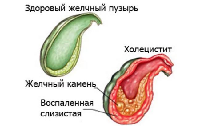 Желчный пузырь: функции, основные заболевания и лечение