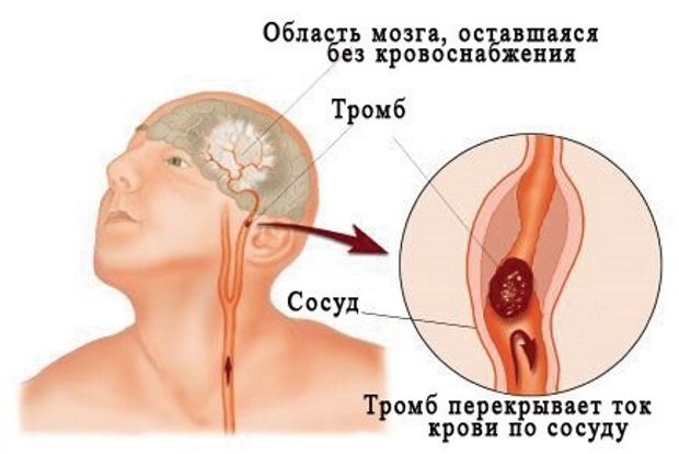 Энцефалопатия головного мозга – что это такое? резидуальная, алкогольная, токсическая, перинатальная, посттравматическая энцефалопатия