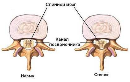 Сколько дней температура при остеохондрозе?