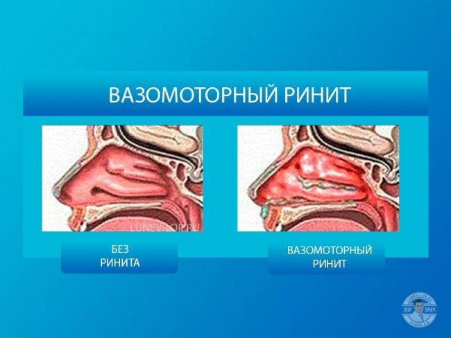 Медикаментозный ринит: симптомы и лечение