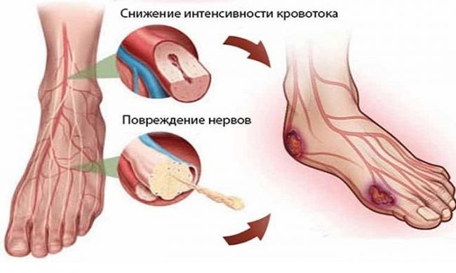 Диабетическая полинейропатия - виды, стадии и лечение
