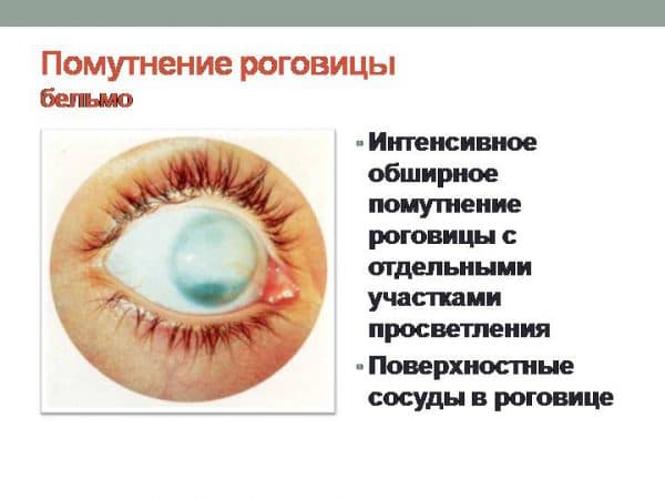 Бельмо на глазу у человека