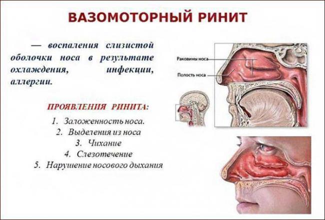 После простуды нос не дышит что делать