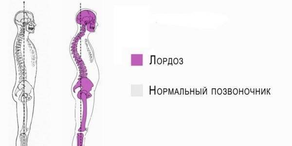 Умирают ли от искривления позвоночника?