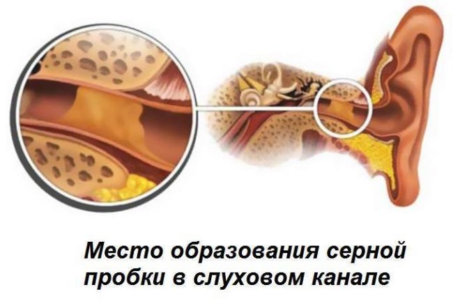 Что делать, если в ухе серная пробка