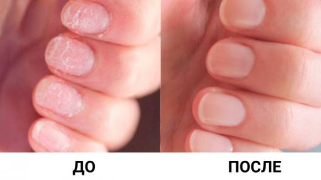 Лучшие домашние средства для ровных ногтей