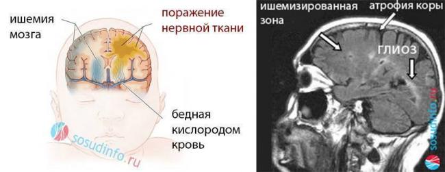 Глиоз головного мозга: лечение, причины, очаги