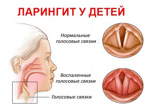Лечение ларингита у взрослых