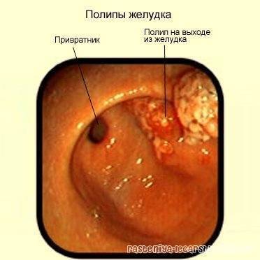 Лечение полипов в носу чистотелом