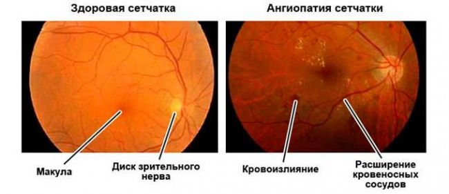 Ангиопатия сетчатки обоих глаз: что это такое, симптомы, лечение
